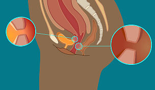wow-l2-obstetric-fistula-id10095-01.jpg